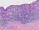 Routinefärbung (Hämatoxylin & Eosin): Malignes Melanom (schwarzer Hautkrebs) mit bösartigen Melanomzellen