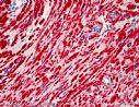 SMA (Glattmuskelaktin): Darstellung eines speziellen Muskelproteins in den glatten Muskelzellen des Leiomyoms