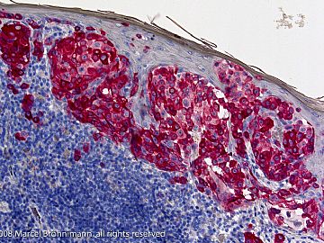 Beispiele immunhistochemische Frbungen