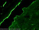 C3c: Nachweis von Komplement C3c-Ablagerungen (leuchtendes Grn) im Dach und am Boden der durch die Autoimmunreaktion verursachten Blase