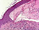 Routinefärbung (Hämatoxylin & Eosin): Randbereich einer Blase bei bullösem Pemphigoid mit subepidermaler Blasenbildung infolge Ablagerungen von hier unsichtbaren Antikörpern (Abwehrstoffen) sowie reichlich eosinophile Granulozyten