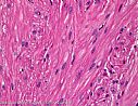 Routinefärbung (Hämatoxylin & Eosin): Leiomyom (gutartiger Tumor aus glatten Muskelzellen)