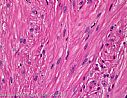 Routinefrbung (Hmatoxylin & Eosin): Leiomyom (gutartiger Tumor aus glatten Muskelzellen)